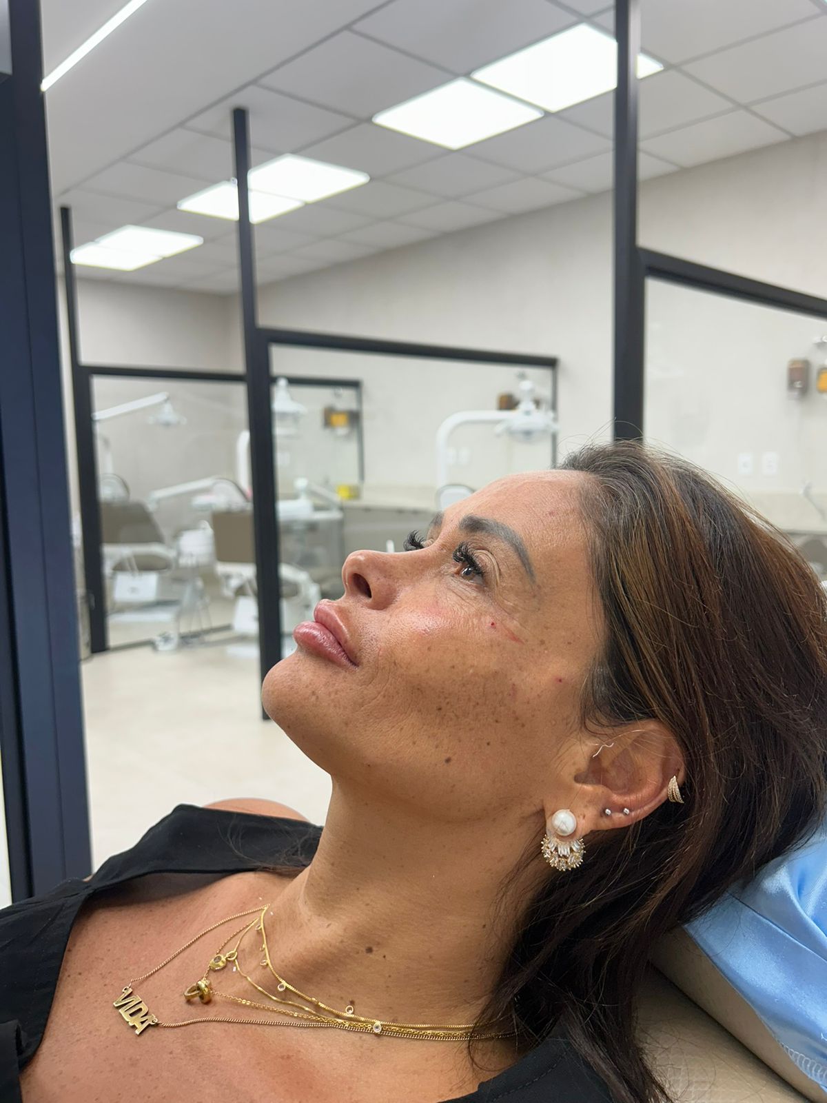Resultado de preenchimento labial — volume natural e definido